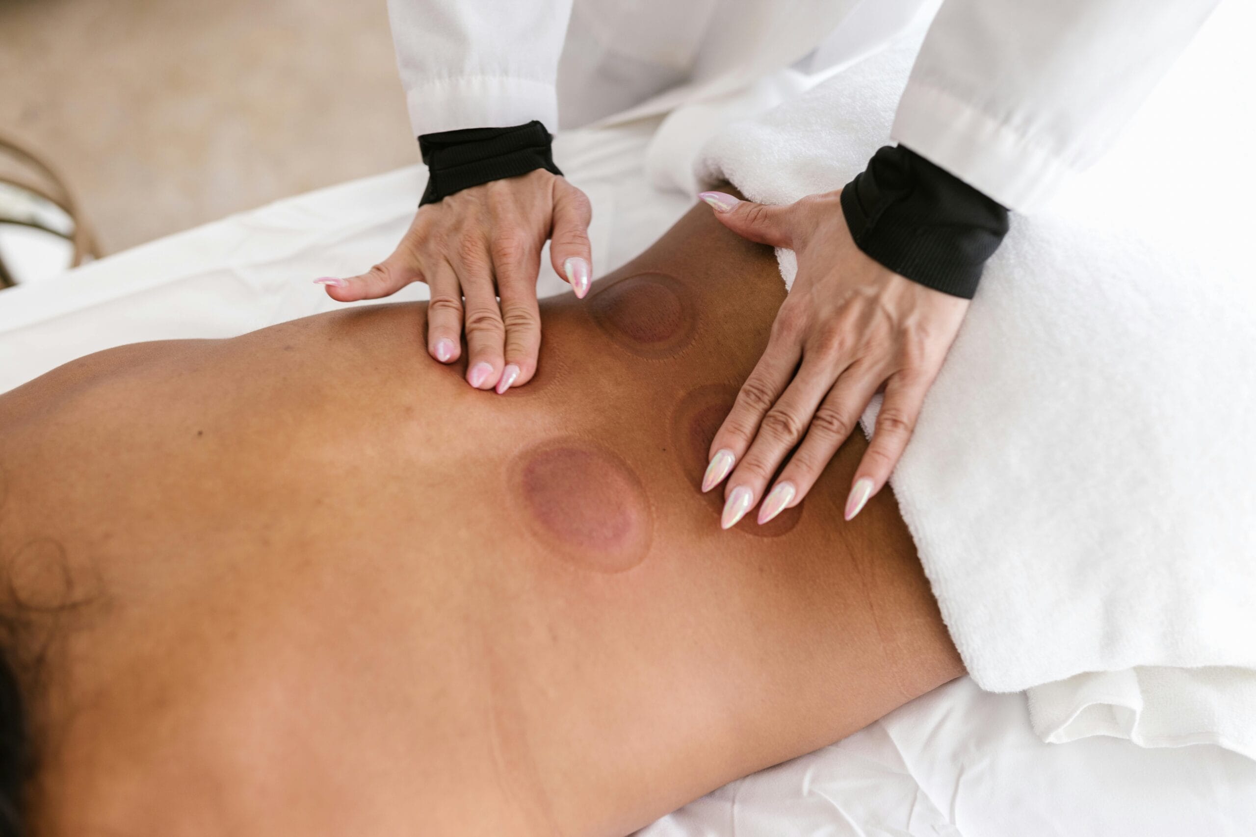 What is Cupping? Benefits and Techniques