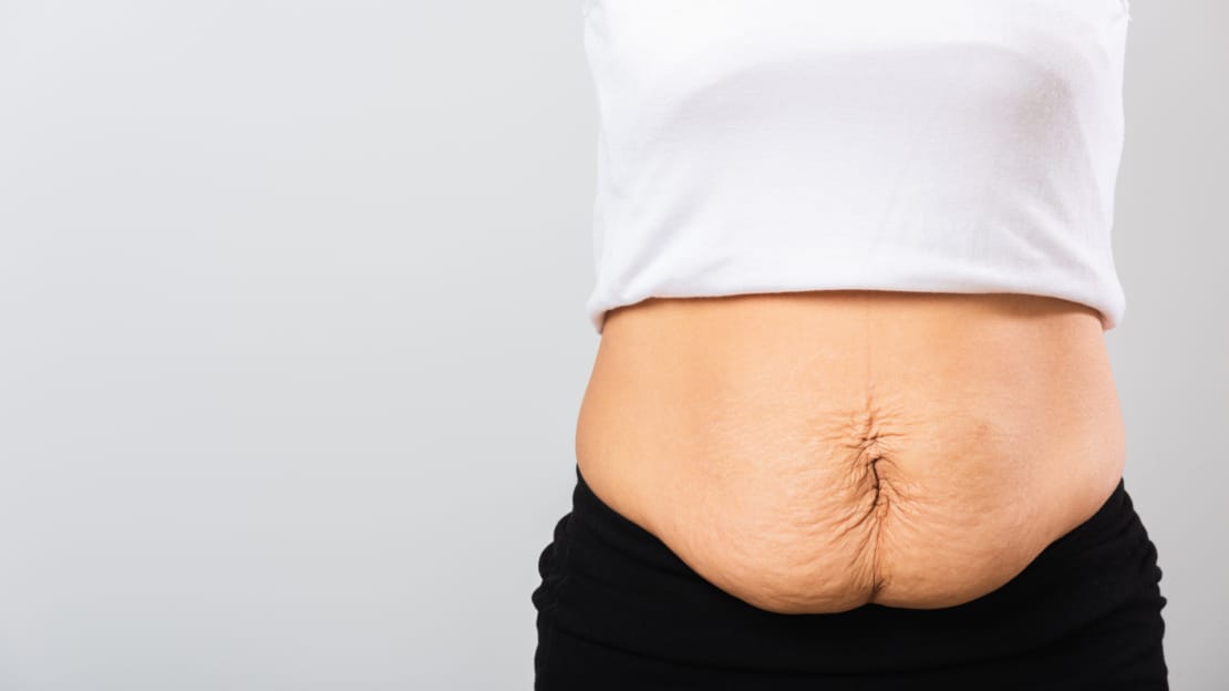 Diastasis Recti Abdominis: Managing the Condition